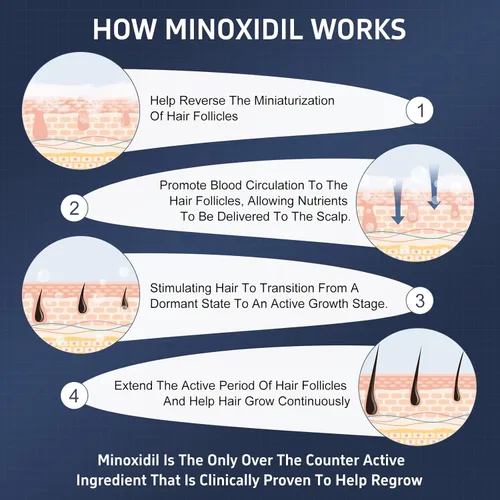 Miniatura 5 de Espuma de minoxidil, 5% de espuma tópica de minoxidil, infundida con biotina, tratamiento para el crecimiento del cabello, minoxidil para hombres
