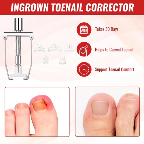 Miniatura 7 de Kit de eliminación de uñas encarnadas, kit de herramientas de uñas encarnadas con corrector de uñas encarnadas, gotas de uñas encarnadas, parche