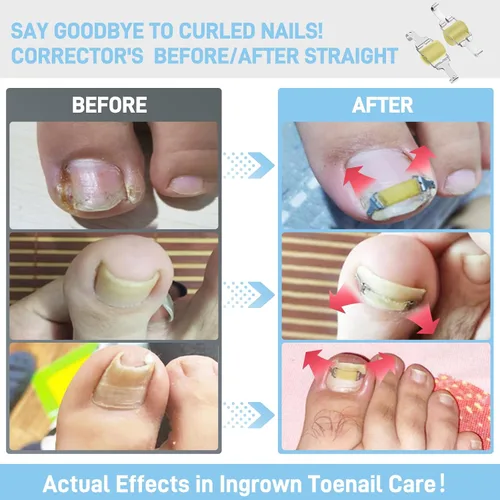 Miniatura 3 de InhwRior Corrector de uñas encarnadas, fácil aplicación en casa, ajuste seguro (sin deslizamiento), tracción constante para alivio rápido del dolor