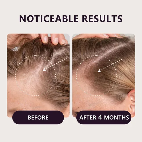 Miniatura 3 de Suero para el crecimiento del cabello de minoxidil al 5% para mujeres: tratamiento de pérdida de cabello extra fuerte con biotina para adelgazar