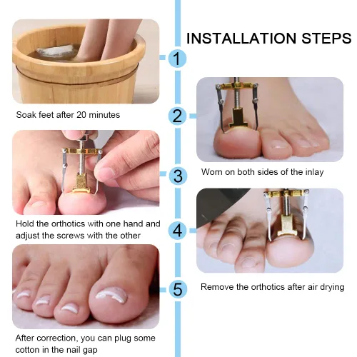 Miniatura 2 de Corrector de uñas encarnadas profesional encarnadas levantador de uñas encarnadas práctica abrazadera para el tratamiento de uñas encarnadas
