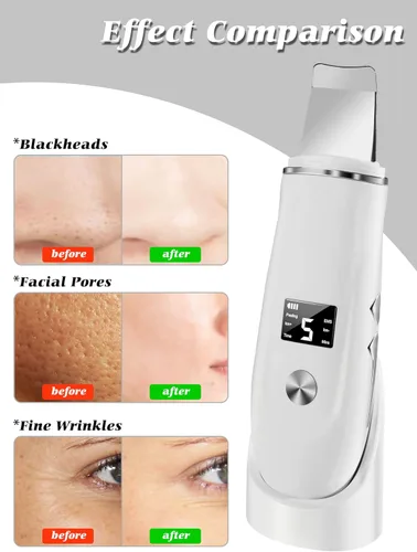 Miniatura 6 de Espátula facial 4 en 1 para limpiar los poros, espátula facial para limpieza facial profunda con cargador USB