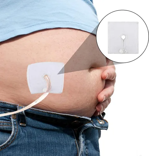 Miniatura 7 de Almohadillas para tubos de alimentación, almohadillas de botón para tubos G, almohadillas para tubos G/J, suministros para tubo de alimentación