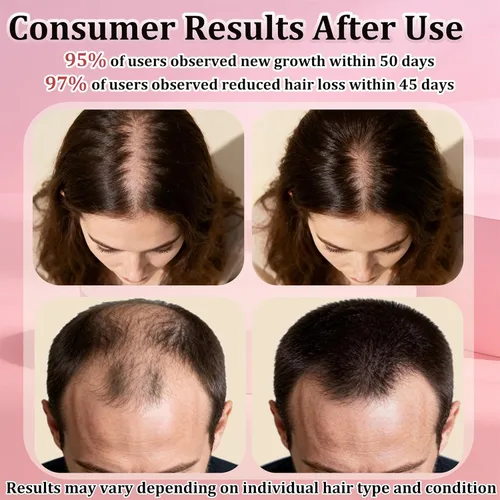 Miniatura 2 de Spray tópico de minoxidil al 5% para hombres y mujeres, tratamiento de crecimiento del cabello con biotina para adelgazar el cabello, línea capilar