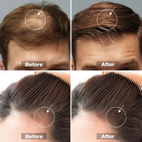 Miniatura 7 de Kit de suero para el crecimiento del cabello de minoxidil al 5% para hombres y mujeres, aceite de suero de biotina para el crecimiento del cabello