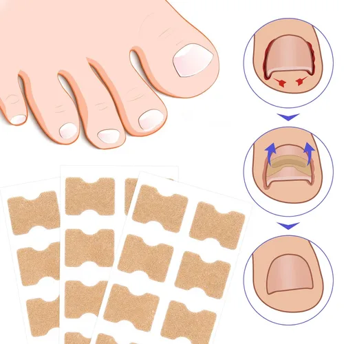 Miniatura 3 de Parche corrector de uñas encarnadas, 100 tiras correctoras de uñas encarnadas, parches de corrección de uñas de los pies, herramienta de tratamiento