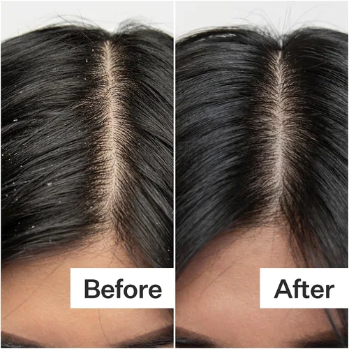 Miniatura 5 de Act+ Acre Exfoliante de ácido salicílico procesado en frío Para escamas sueltas, exceso de aceite, acumulación de cuero cabelludo Ácido
