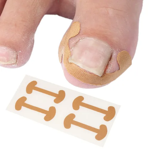 Juego de corrector de uñas encarnadas con tiras correctoras, kit profesional de eliminación de uñas encarnadas, tiras de corrección de uñas y uñas