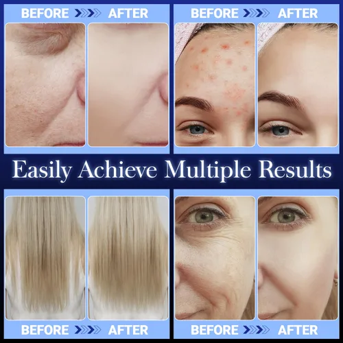 Miniatura 4 de Uaike - Varita facial de alta frecuencia, portátil, portátil, de mano, azul, de alta frecuencia, para el hogar, dispositivo de varita facial con 4