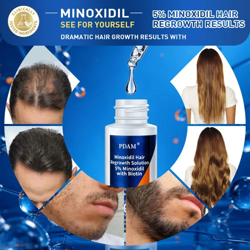 Miniatura 7 de Minoxidil para el crecimiento del cabello para hombres y mujeres, 2 onzas líquidas (paquete de 4 goteros)