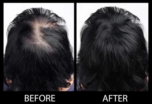 Miniatura 6 de Fibras capilares voluminizadoras con queratina real para adelgazar el cabello/pérdida de cabello – Dermatológicamente probado y certificado