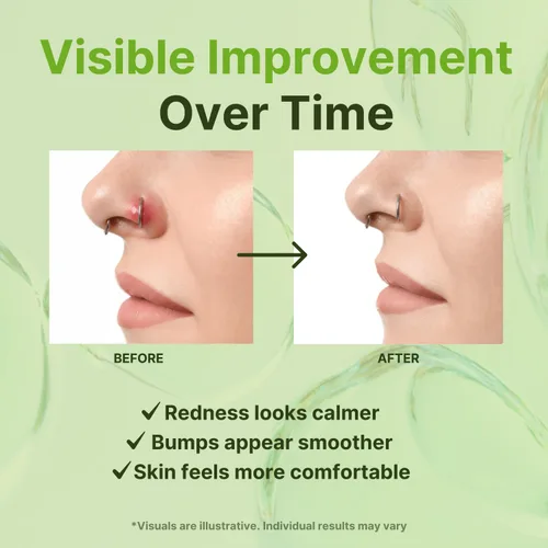 Miniatura 6 de Tobcharm Solución para perforar el bulto – Piercing Bump para oído, nariz y cuerpo – Alivia las protuberancias queloides, reduce el enrojecimiento