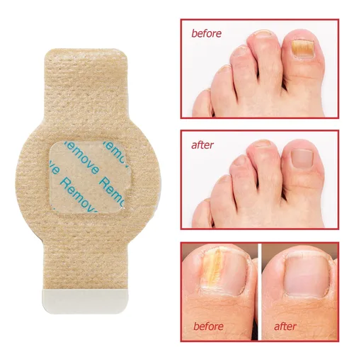 Miniatura 7 de Parches de uñas, parches de uñas para uñas de los pies, parches de tratamiento de uñas extra fuertes, yesos de uñas extra fuertes de 8 horas