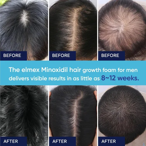Miniatura 6 de Espuma de minoxidil al 5 % para hombres y mujeres, minoxidil para el crecimiento del cabello, tratamiento extra fuerte para el crecimiento