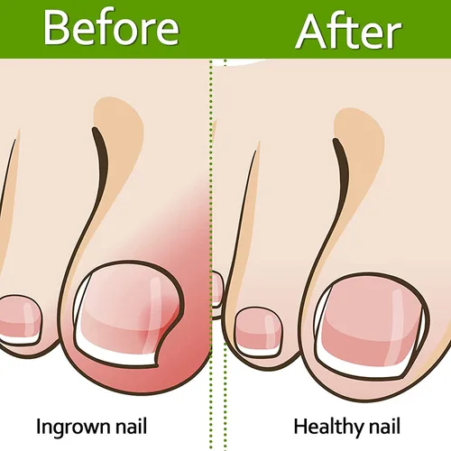 Miniatura 3 de Tiras correctoras de uñas encarnadas profesionales, 50 tiras correctoras de uñas encarnadas, tiras curvadas para enderezar las uñas del pie, clips