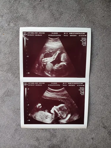 Miniatura 2 de Broma de ultrasonido 2D personalizada falsa con dos fotos conectadas B&W