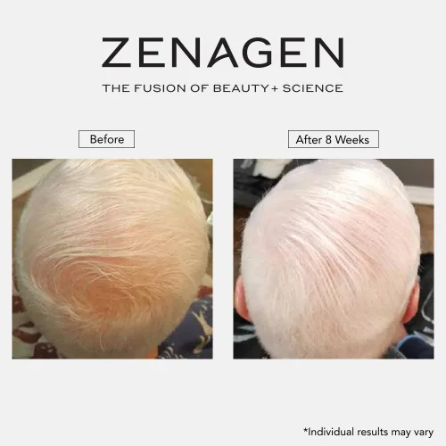 Miniatura 10 de Zenagen Revolve - Tratamiento de pérdida de cabello para hombres