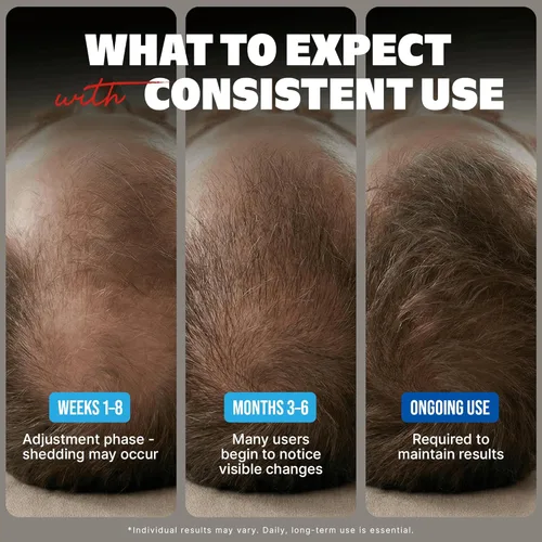 Miniatura 4 de Kirkland Signature Minoxidil Solución tópica USP 5%, tratamiento de crecimiento capilar extra fuerte para hombres, suministro de 6 meses