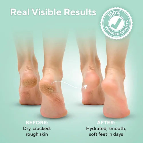 Miniatura 3 de Lavinso Crema de urea 40 por ciento para pies con máxima fuerza, crema de pies para callos y talones agrietados secos, reparación de piel áspera