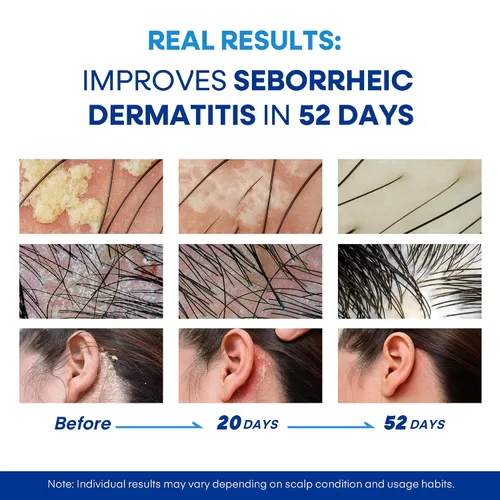 Miniatura 3 de Champú medicado para la dermatitis seborreica del cuero cabelludo y la psoriasis: Fórmula a base de plantas alivia la picazón, reduce las escamas