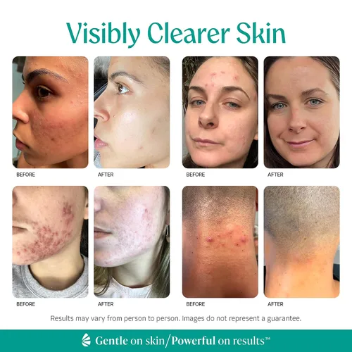 Miniatura 4 de Suero limpiador facial y corporal con ácido mandélico almendra, nivel 1 para acné, foliculitis, piel envejecida, pelos encarnados, manchas oscuras