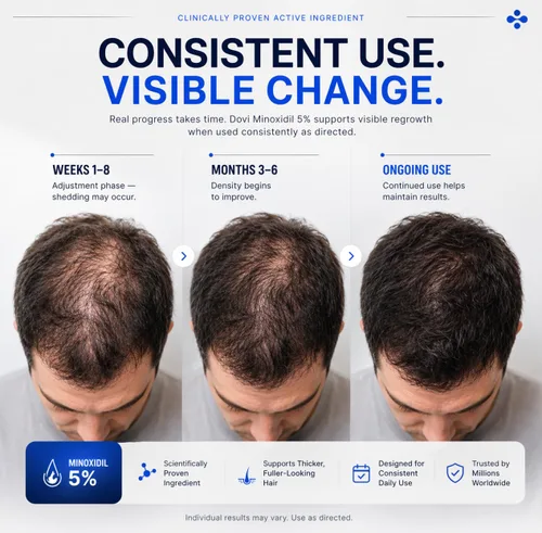Miniatura 3 de Dovi Minoxidil - Tratamiento para el crecimiento del cabello al 5% para hombres, solución tópica avanzada extra fuerte, suministro de 6 meses, ayuda