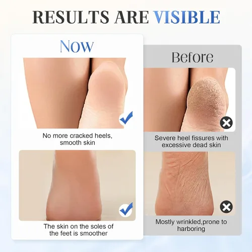 Miniatura 4 de Crema para pies 60% urea, hidratante profunda, antigrietas para pieles secas, duras y ásperas, fórmula mejorada repara, suaviza, suaviza, crema