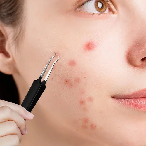 Miniatura 5 de Honoson 3 pinzas de espinillas de acero inoxidable, herramienta extractora para quitar espinillas de espinillas curvas, herramientas para quitar