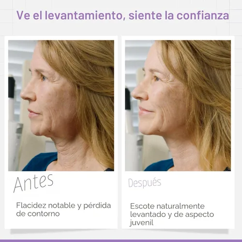 Miniatura 4 de NECK LESS Tiras profesionales de estiramiento facial – Cinta instantánea de elevación de mandíbula y cuello Solución de grado médico, invisible