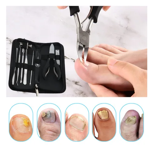 Miniatura 3 de Bcabo Kit de herramientas de uñas encarnadas, herramienta de pie de tratamiento de uñas, cortaúñas encarnadas, cortaúñas encarnadas, levantador