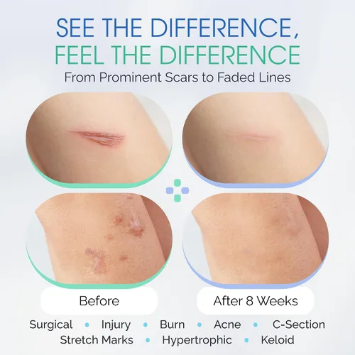 Miniatura 6 de Suero de gel para cicatrices de silicona 100% – Aplicador de cepillo ultrasuave para procedimientos cosméticos y exfoliaciones faciales, cuidado