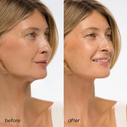 Miniatura 4 de Máscara de elevación V Line de MAREE con ácido hialurónico – Máscara facial profunda de colágeno para mujeres – Máscaras faciales moldeadoras