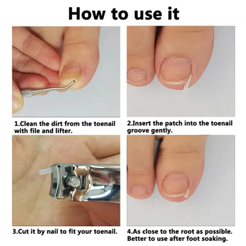 Miniatura 4 de Tratamiento de uñas encarnadas, 50 tiras correctoras de uñas encarnadas transparentes, herramienta profesional de tratamiento de uñas sin pegamento