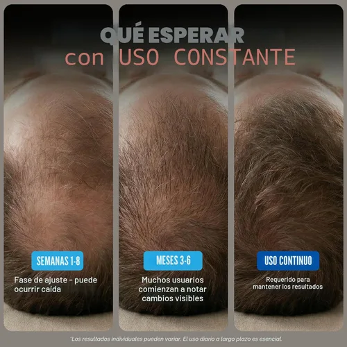 Miniatura 4 de Minoxidil para hombres Paquete Líquido, Tratamiento de crecimiento del cabello de fuerza extra 5%, suministro para 6 meses - Aplicador con gotero