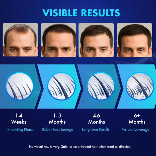 Miniatura 6 de Crecimiento del cabello de minoxidil al 5% para hombres y mujeres: solución tópica de minoxidil extra fuerte para adultos con líneas de cabello