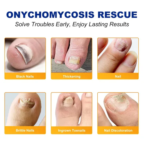 Miniatura 4 de Tratamiento de uñas de los pies extra fuerte, 8 horas de reparación de uñas durante la noche, tratamiento de uñas encarnadas, fortalece las uñas