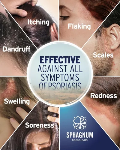 Miniatura 2 de Sphagnum Botanicals Champú de psoriasis con ácido salicílico para mujeres y hombres, alivio natural para cuero cabelludo seco, picazón, escamoso