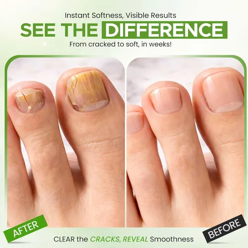 Miniatura 6 de Urea Nail Gel - Suaviza los callos agrietados del talón y las uñas gruesas de los pies - Repara uñas dañadas, amarillas y decoloradas - Tratamiento
