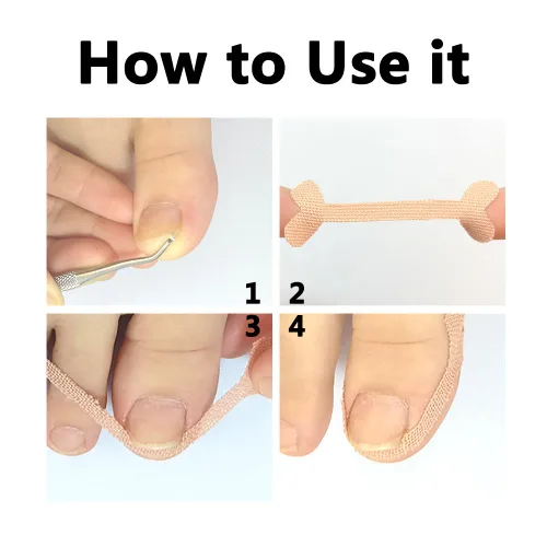 Miniatura 3 de Tratamiento de uñas encarnadas, 50 parches correctores de uñas encarnadas, calcomanías de corrección de uñas de los pies, herramienta profesional