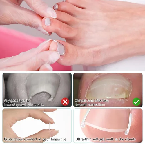 Miniatura 3 de (50+1) Juego de tratamiento corrector de uñas encarnadas, kit profesional de eliminación de uñas encarnadas sin dolor con levantador de uñas