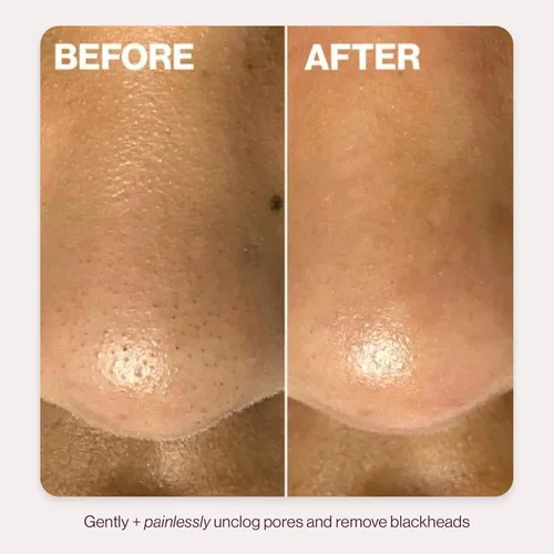 Miniatura 5 de DERMAFLASH DERMAPORE+ Dispositivo de cuidado de la piel, extractor ultrasónico de poros 2 en 1 e infusor para el cuidado de la piel, rubor
