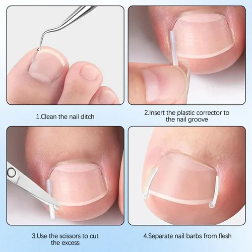 Miniatura 7 de Juego de corrector profesional de uñas encarnadas con tiras correctoras, kit de eliminación de uñas encarnadas, juego de herramientas de pedicura