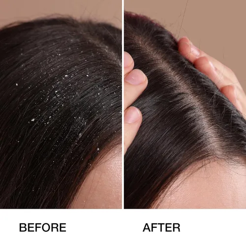 Miniatura 2 de GK HAIR Champú anticaspa que deja tu cuero cabelludo fresco y suave - Champú sin sulfato para cabello seco dañado para hombres y mujeres, 8.5 onzas