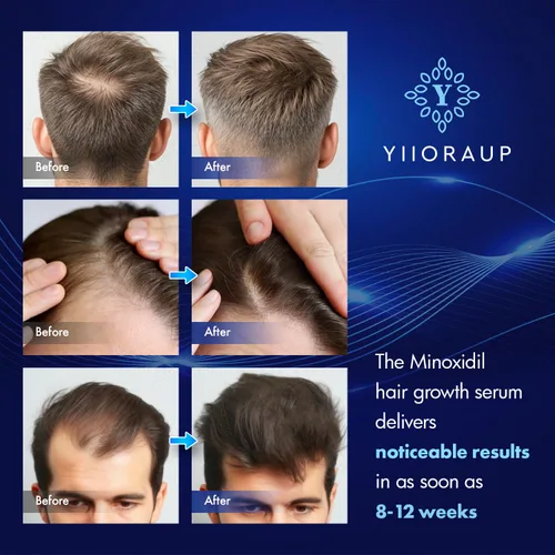 Miniatura 5 de Crecimiento del cabello de minoxidil al 5% para hombres y mujeres: solución tópica de minoxidil extra fuerte para adultos con líneas de cabello