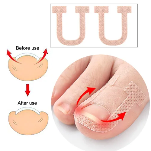 Miniatura 5 de Paquete de 40 parches correctores de uñas encarnadas en forma de U, correctoras de uñas de los pies, parches de corrección, vendajes para alivio