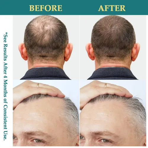 Miniatura 4 de Spray de aceite natural para el crecimiento del cabello: suero de romero Batana, biotina, cafeína, tratamiento para el cuidado del cuero cabelludo