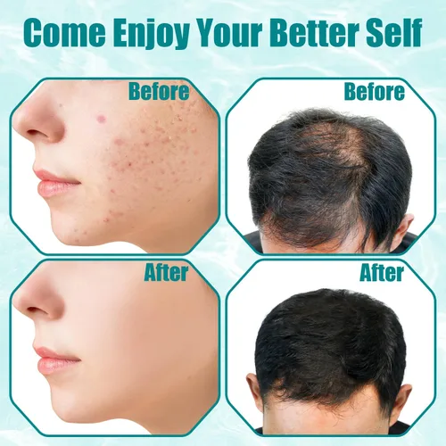 Miniatura 5 de TUMAKOU - Varita facial de alta frecuencia, máquina portátil de piel facial de alta frecuencia con luz violeta - con 6 tubos de vidrio (blanco)
