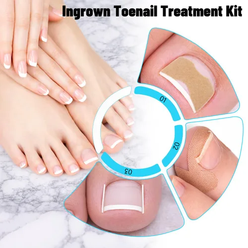 Miniatura 4 de Kit de eliminación de uñas encarnadas mejorado 2026, tratamiento de uñas encarnadas, corrector de uñas encarnadas de acero inoxidable, herramienta
