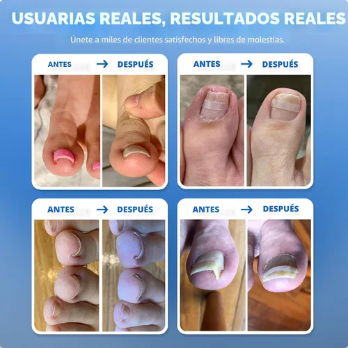 Miniatura 3 de Tratamiento del hogar para uñas encarnadas CurveCorrect