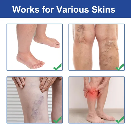 Miniatura 3 de Crema para venas varicosas para piernas, pies y tobillos, crema para el cuidado del edema, mejora la apariencia de la piel y las molestias, alivia